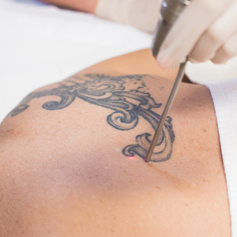 Tattooentfernung Mit Laser Estetika Nobilis
